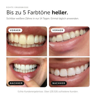 Whitening Strips